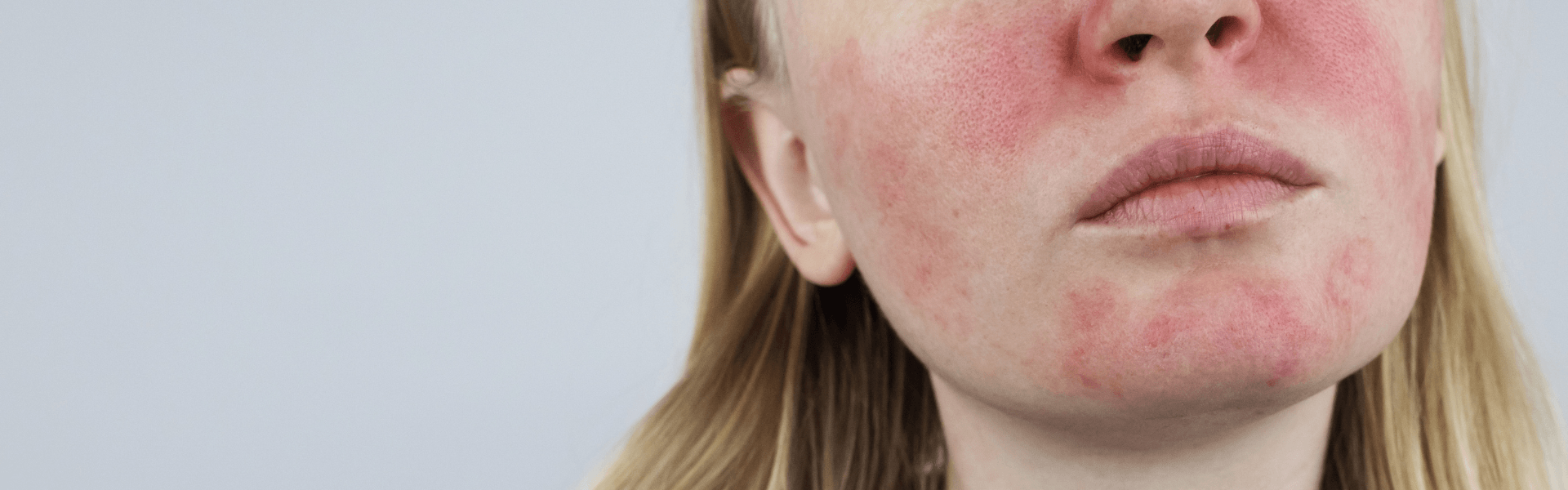 Red Blotchy Spots On Face Images And Photos Finder - vrogue.co